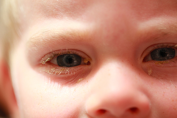 เยื่อตาขาวอักเสบจากเชื้อแบคทีเรีย
