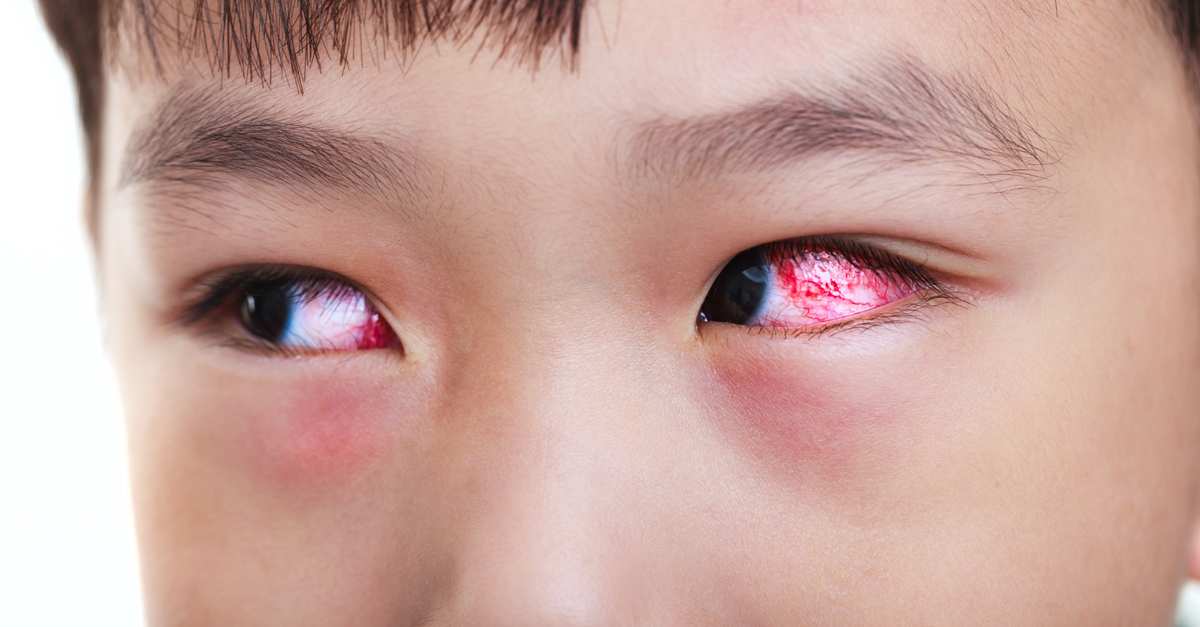 เยื่อตาขาวอักเสบจากไวรัส,โรคตาแดงระบาด