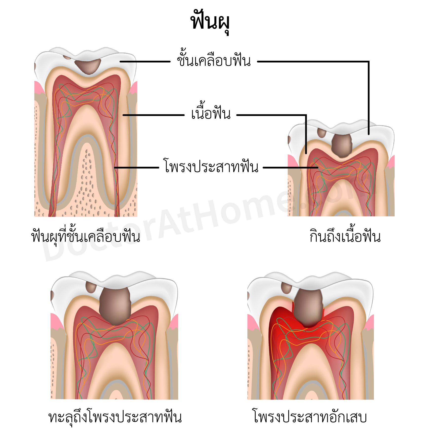 ปวดฟัน ฟันผุ (Dental Caries/Tooth Decay) ข้อมูลโรค  พร้อมโปรแกรมตรวจอาการเบื้องต้น