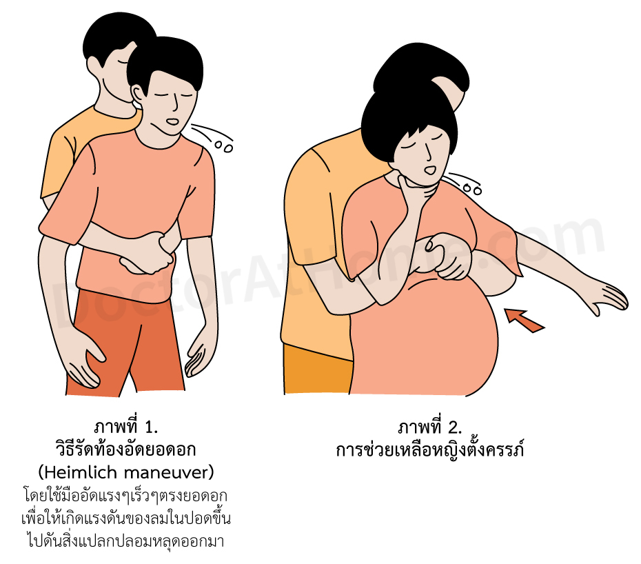 สำลักอาหารหรือสิ่งแปลกปลอม (Choking/Foreign body aspiration), ทางเดิน ...