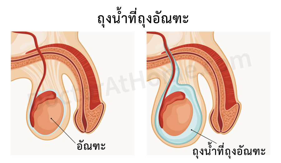 ถุงน้ำที่ถุงอัณฑะ/กล่อนน้ำ