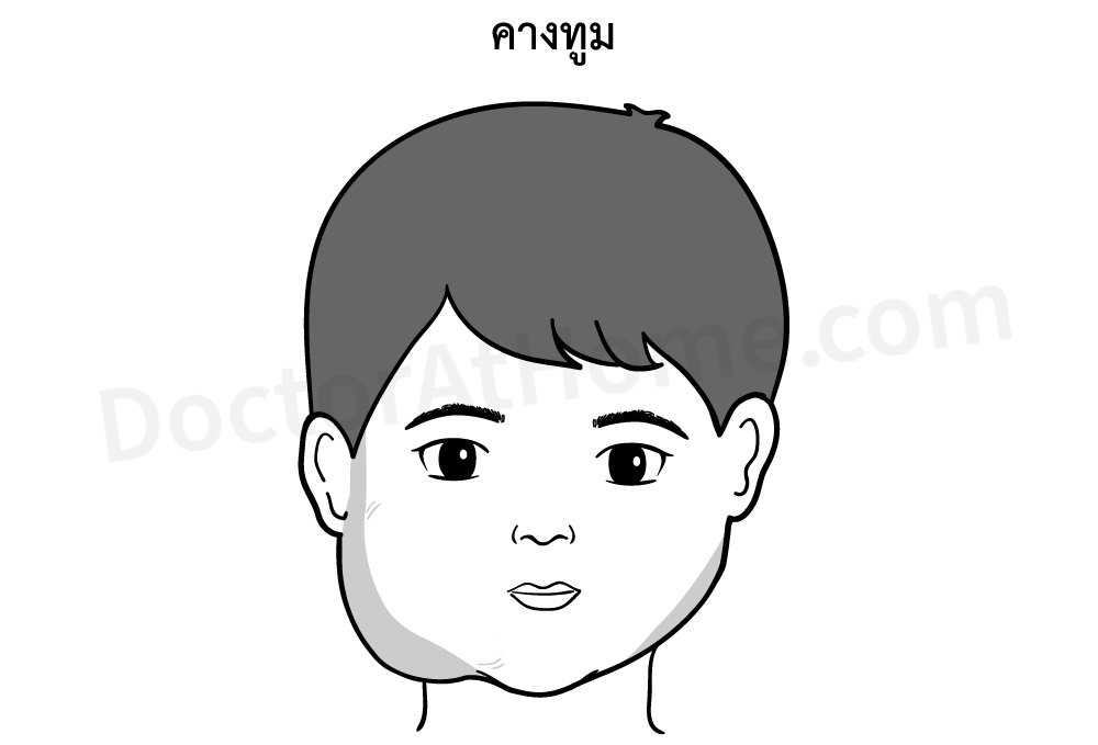 คางทูม