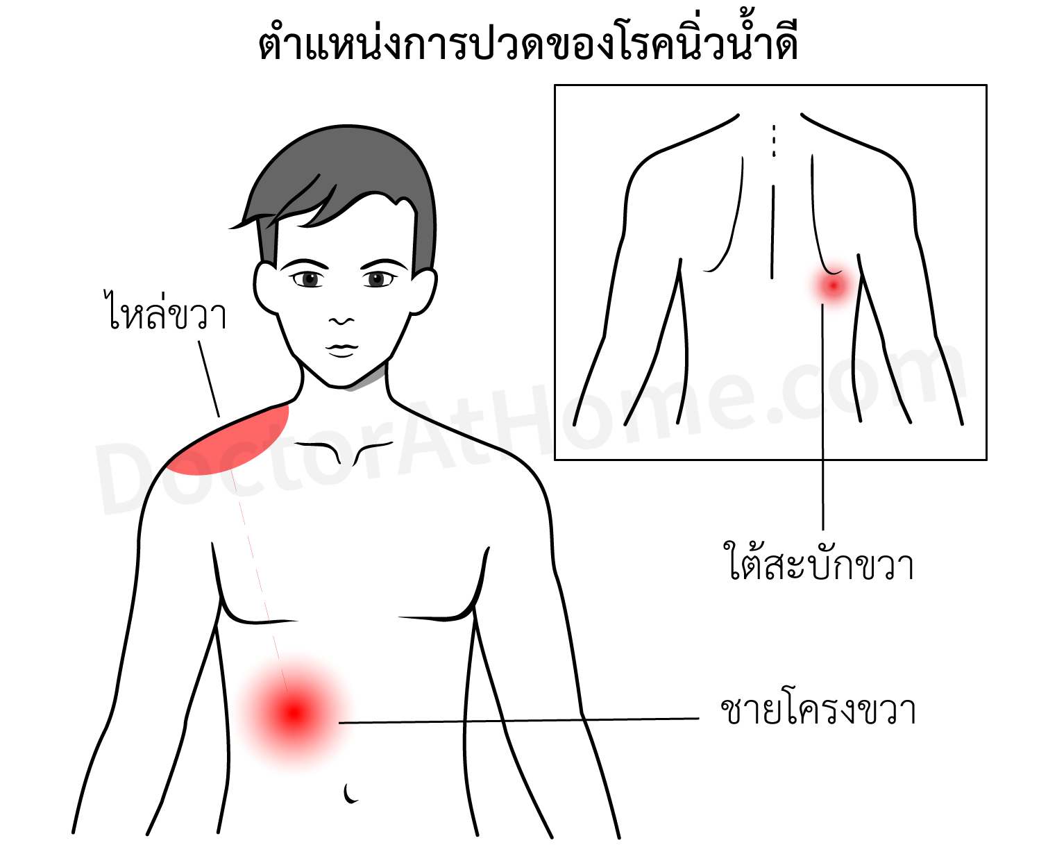 นิ่วน้ำดี