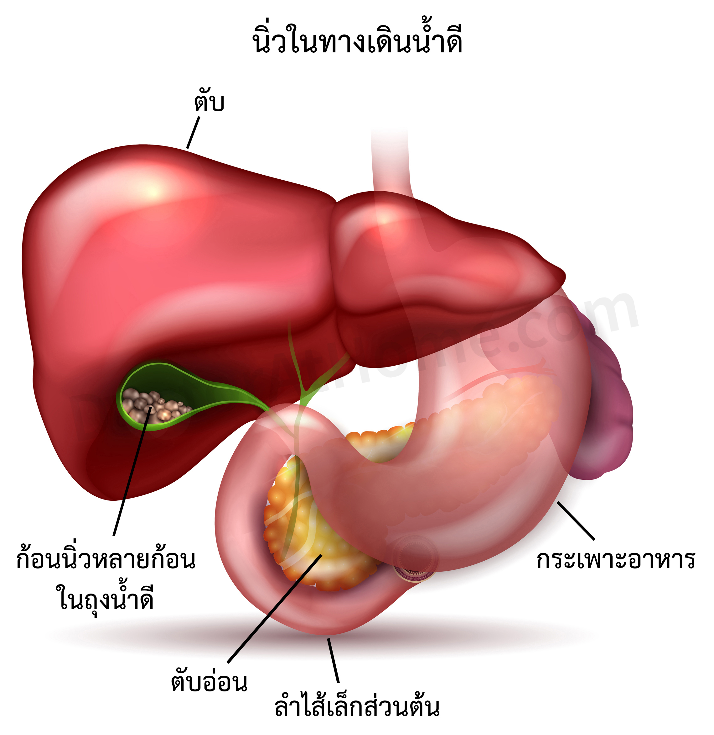 นิ่วน้ำดี